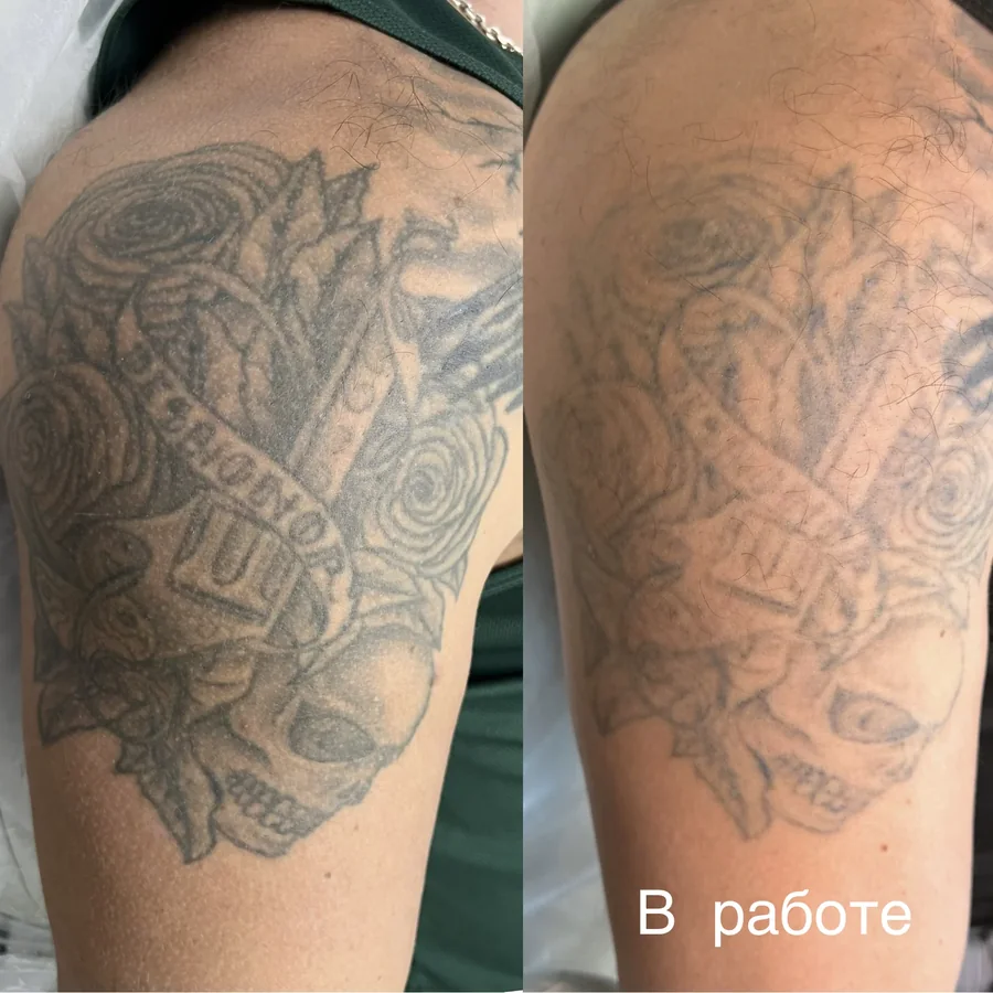 Лазерное удаление тату и перманента, фото 1